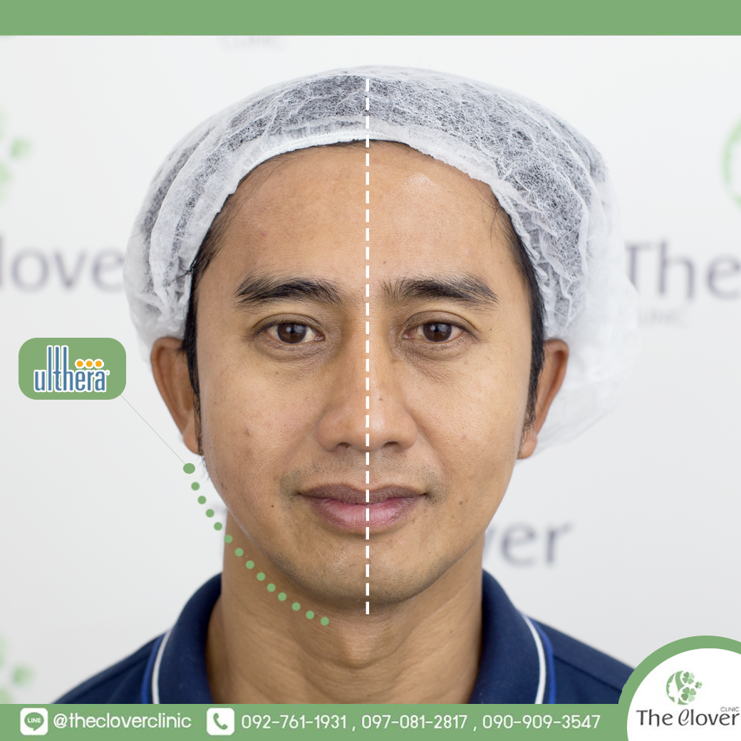 Ulthera ภาพรีวิวก่อน และหลังทำ ร่องแก้มจางลง ผิวกระชับแน่นยกขึ้นอย่างเห็นได้ชัด ช่วยให้กรอบของหน้ามีความชัดเจนขึ้น