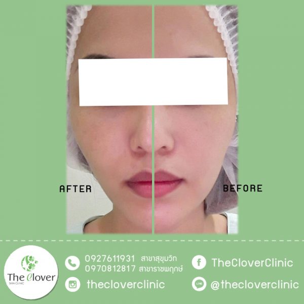 HIFU รีวิวจากผู้ทำ