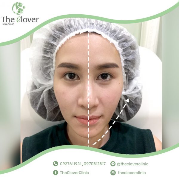 HIFU รีวิวจากผู้ทำ